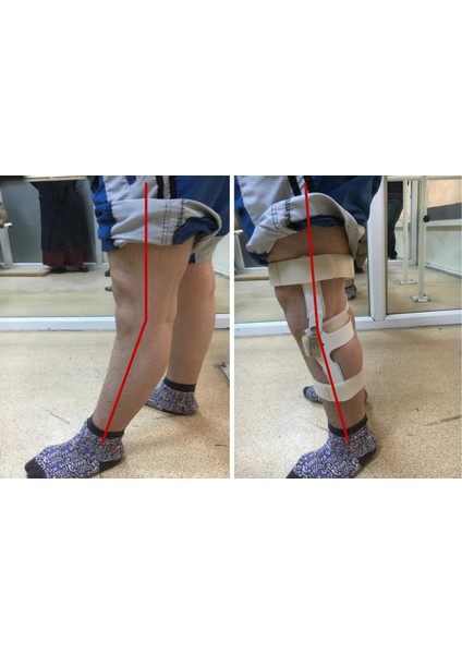 Isveç Diz Ortezi (Yetişkinler Için) -Diz Rekurvatum Ortezi - Dizin Geriye Kaçmasını Engelleyen Dizlik fiyatları