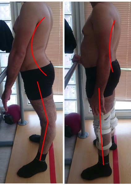 Isveç Diz Ortezi (Yetişkinler Için) -Diz Rekurvatum Ortezi - Dizin Geriye Kaçmasını Engelleyen Dizlik modelleri