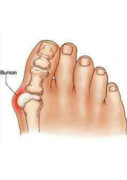 Ayak Başparmak Ayırıcı Kemik Bunyon Nasır Silikon Makara