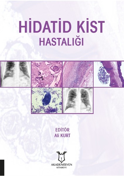 Hidatid Kist Hastalığı - Ali Kurt