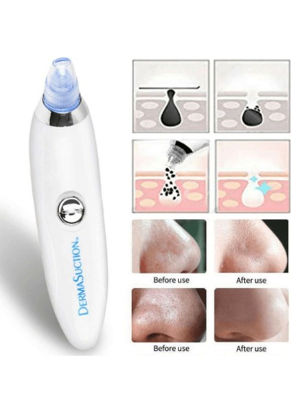 Apaydın Pilli Siyah Nokta Vakum Cihazı fiyatları