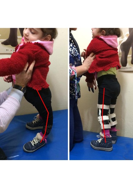 Karma Grup Ortopedı Isveç Diz Ortezi (Çocuklar Için) -Diz Rekurvatum Ortezi - Dizin Geriye Kaçmasını Engelleyen Dizlik fiyatları