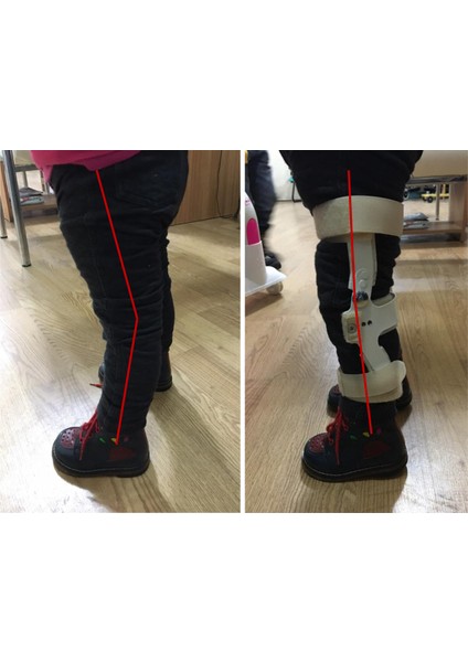 Karma Grup Ortopedı Isveç Diz Ortezi (Çocuklar Için) -Diz Rekurvatum Ortezi - Dizin Geriye Kaçmasını Engelleyen Dizlik modelleri