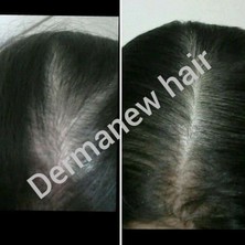 Dermanew 3 Adet Serum + Roller Dermanew hair Bayanlara Özel Serum