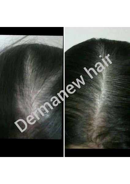 3 Adet Serum + Roller Dermanew hair Bayanlara Özel Serum