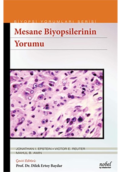 Mesane Biyopsilerinin Yorumu - Biyopsi Yorumları Serisi