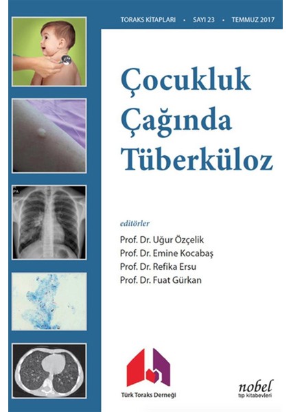 Çocukluk Çağında Tüberküloz Tanı: Tedavi ve Korumada Güncel Yaklaşımlar ve Olgu Örnekleri