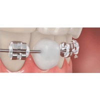 Dentalsepet Ortodonti Mumu - Diş Teli Mumu - Ortodontik Wax