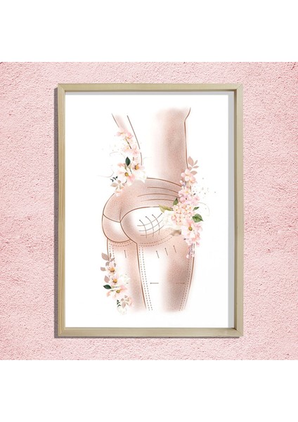 Breziya Poposu, Popo Kaldırma Sanatı, Plastik ve Estetik Cerrahı, Doktor Odası Duvar Tablosu