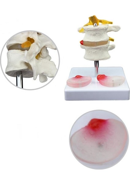 Lumbar Vertebra Disk Hernisi Omurga Modeli Model 4