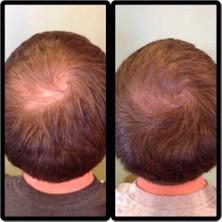 Aveda Hair Loss Prevention Invati Men Scalp Natural And Vegan Revitalizer Hair Serum For Males 125 ml