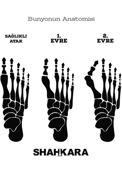 Makaralı Başparmak Bunyuon Kemik Koruyucu (Çift)