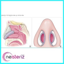 EuroCell Doyle Internal Silikon Nasal Splint - Silikon Burun Splinti