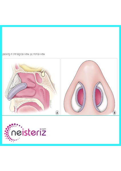 Doyle Internal Silikon Nasal Splint - Silikon Burun Splinti