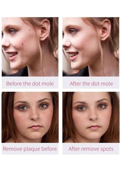 Mole Dövme Çıkarma Koyu Nokta Çıkarma Lazer Çil Çöp Çıkarma Makinesi Cilt Güzellik Enstrüman Salon Güzellik Makinesi | Evde Güzellik Cihazları