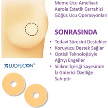 Luofucon Silikon Skar  Halka Areola Estetik Meme Ucu  Küçültme Ameliyat Izi Tedavisi Areopksi 2'li