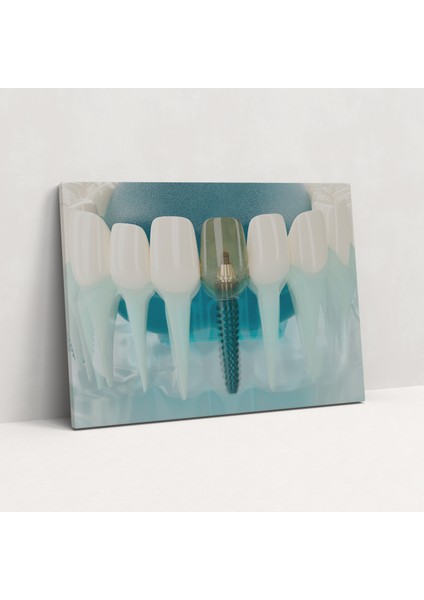 Diş Implantı Modelleme Kanvas Tablo