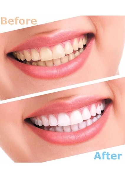 Diş Beyazlatma Seti fiyatları