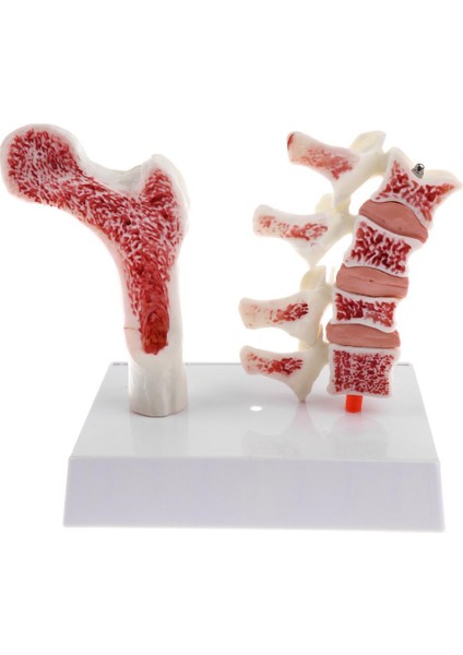 1: 1 Insan Osteoporoz Iskeleti Pathologica Modeli, Laboratuvar Gösteri Ekranı (Yurt Dışından)