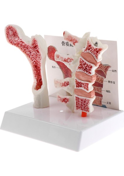1: 1 Insan Osteoporoz Iskeleti Pathologica Modeli, Laboratuvar Gösteri Ekranı (Yurt Dışından)