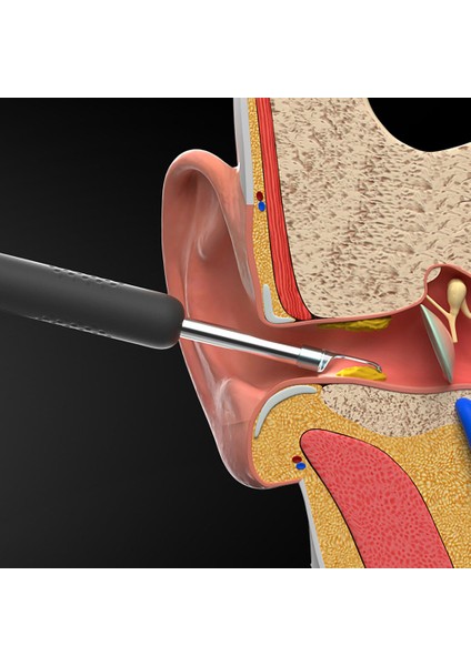 R1 Kablosuz Akıllı Görsel Otoskop Kulak Temizleyici (Yurt Dışından)