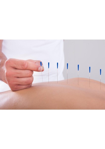 Akupunktur Iğnesi Kuru Iğne, Acupuncture Needle 0.30*50MM