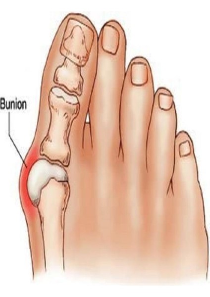 Ayak Başparmak Kemiği Çıkıntısı Bunyonu Düzeltici Halluks Vallgus Ayak Sağlığı Ateli 1 Çift