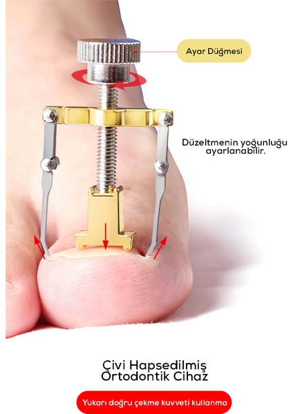 Tırnak Batık Çıkarıcı Alet fiyatları