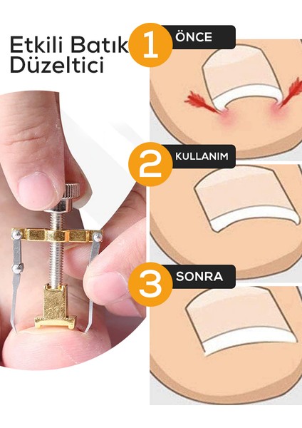 Tırnak Batık Çıkarıcı Alet indirimleri