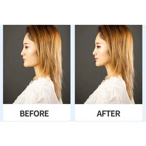 Lasting Beauty Kaş Germe Göz Germe Yüz Gerdirme Ipli Toka Çekik Göz