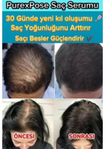 Saç Bakım Serumu 2 Adet+1 Adet Dermaroller