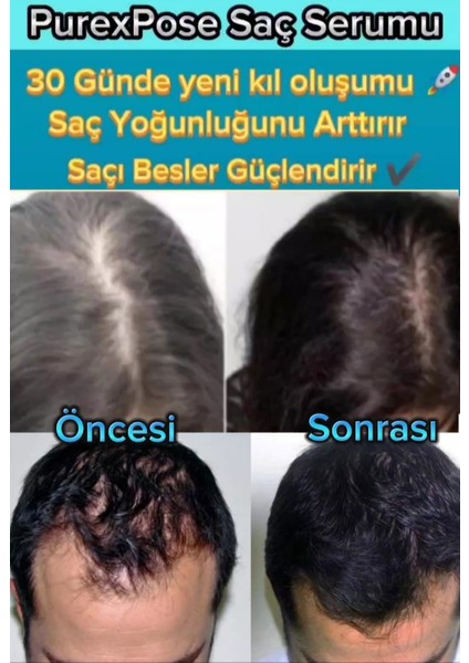 Saç Bakım Serumu 2 Adet+1 Adet Dermaroller