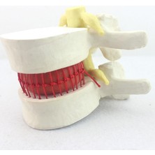 Naturachi Disk Hernisi Fıtık Maketi Model 2