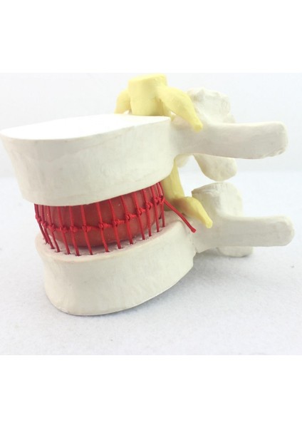 Disk Hernisi Fıtık Maketi Model 2