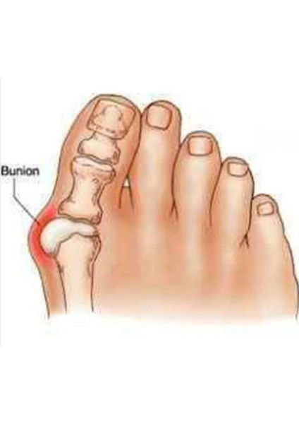 Ayak Başparmak Ayırıcı Kemik Bunyon Koruyucu Silikon Makara modelleri