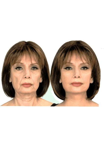 Yüz Gerdirme Bandı Oluşumunu Engelleme Bandı Yüz Germe 5cm 5 mt fiyatları