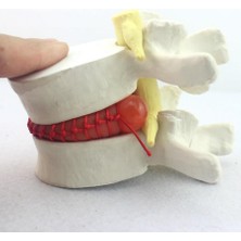 Fizyofiplus Disk Hernisi Fıtık Maketi Model 2