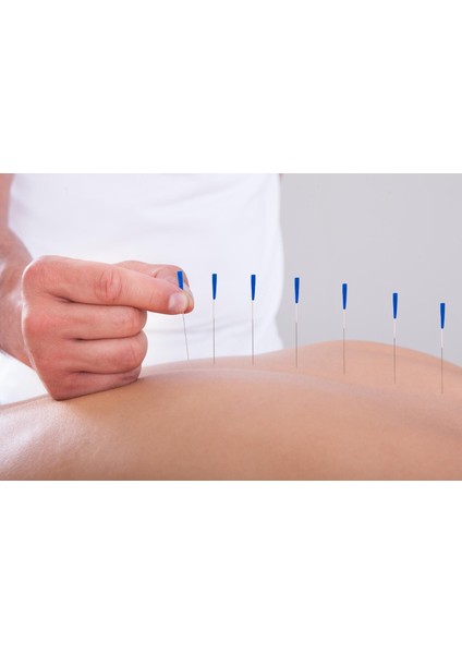 Akupunktur Iğnesi kuru Iğne, acupuncture Needle 0.35*100MM