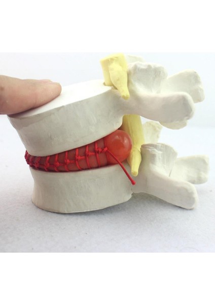 Disk Hernisi Fıtık Maketi Model 2