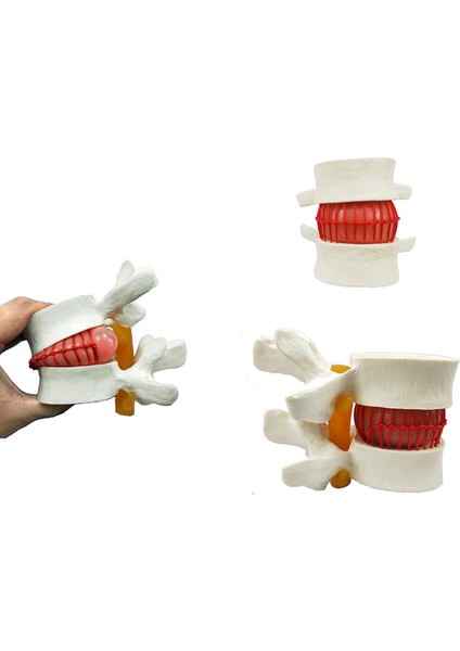 Disk Hernisi Fıtık Maketi Model 2