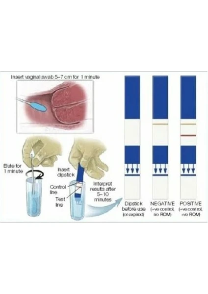 Fetal Membran Yırtığı Testi