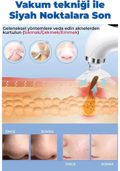 Sterilizasyonlu Vakumlu Cilt Gözenek Siyah Nokta Temizleyici modelleri