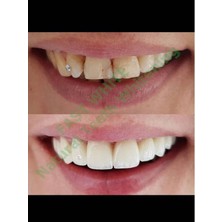 Fast White Natural Teeth Whitening 10 ml Diş Beyazlatma ve Tartar Temizleme