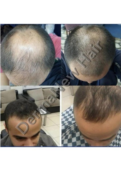 Dermanew Hair Saç Losyon Bakım 3 Adet Serum + Roller 3X50ML indirimleri