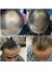 Dermanew Hair Saç Losyon Bakım 3 Adet Serum + Roller 3X50ML 5