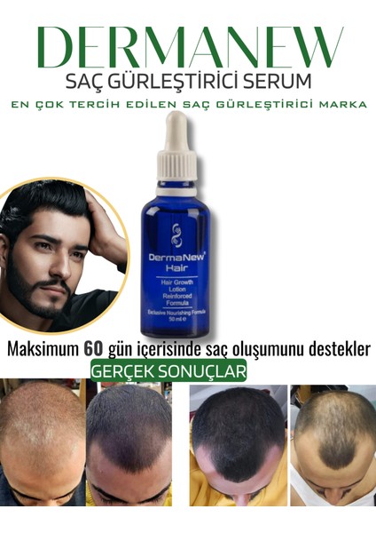 Dermanew Hair Losyon / 5 Losyon +Roller +Şampuan