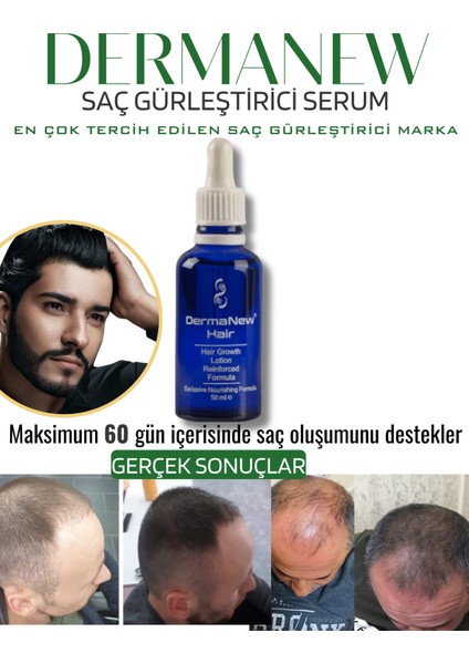 Dermanew Hair Losyon / 5 Losyon +Roller +Şampuan