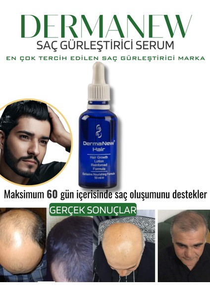 Dermanew Hair Losyon / 5 Losyon +Roller +Şampuan