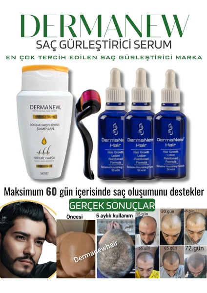 Dermanew Hair Losyon / 3 Losyon +Roller +Şampuan