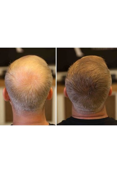 Fixplant 4 Şişe Saç Fiberi + Kaş Dolgulandırıcı